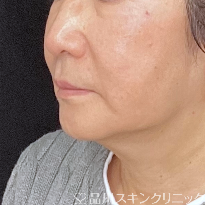 症例NO.75090のAFTER写真