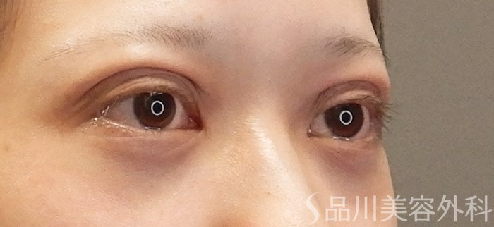 症例NO.71450のAFTER写真
