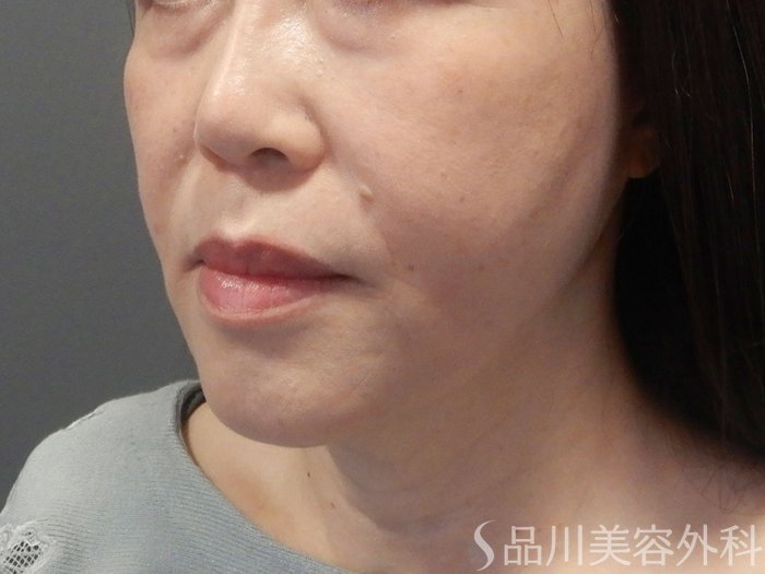 症例NO.70991のAFTER写真