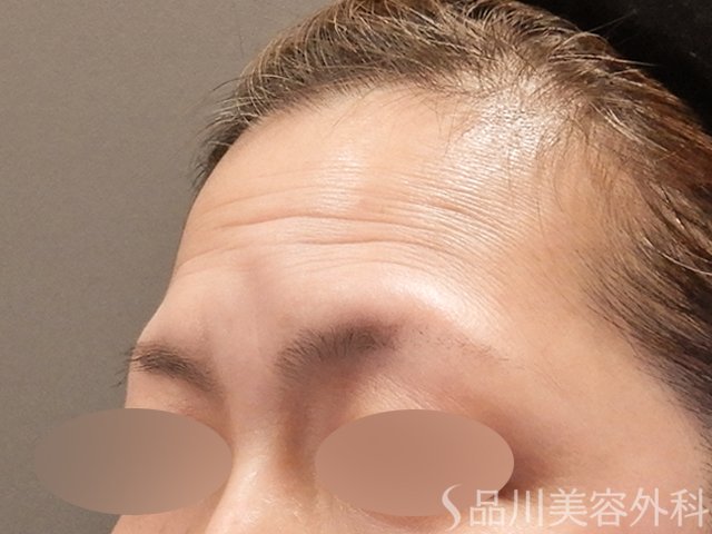 症例NO.72800のBEFORE写真