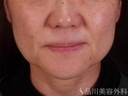 症例NO.72353のBEFORE写真