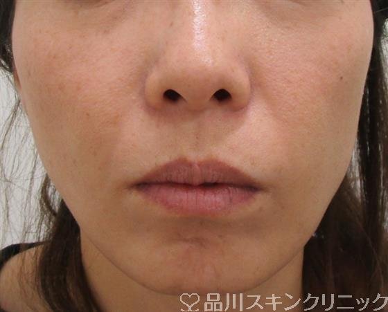 症例NO.43048のBEFORE写真