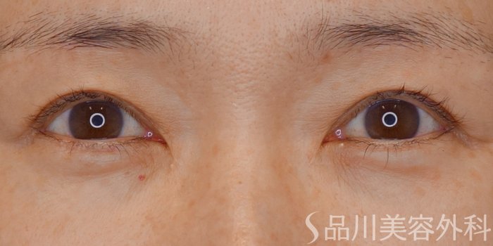 症例NO.72104のBEFORE写真