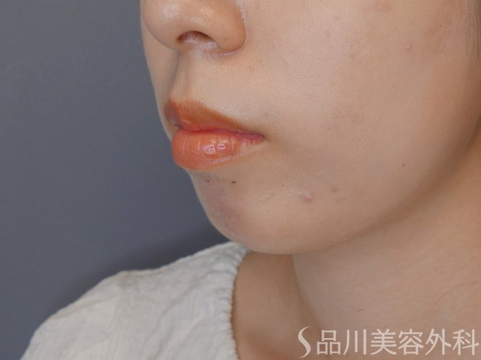 症例NO.70681のBEFORE写真