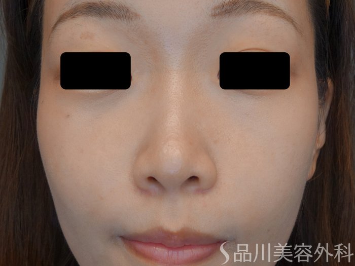 症例NO.74012のAFTER写真