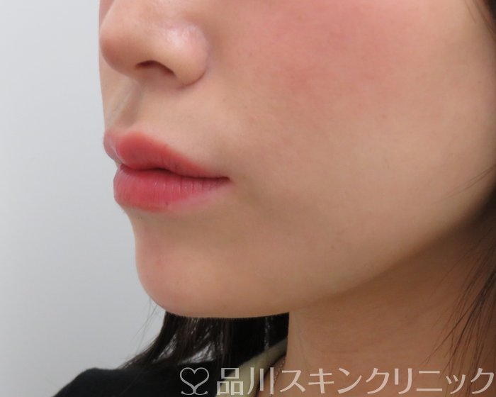 症例NO.65630のAFTER写真