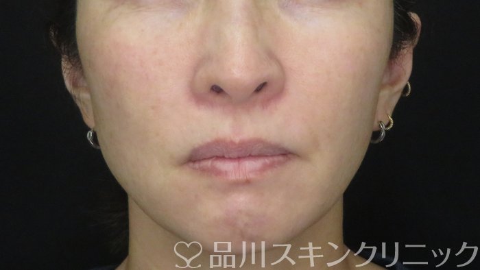 症例NO.71677のBEFORE写真