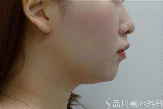 症例NO.61570のBEFORE写真