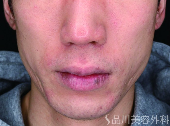 症例NO.75066のBEFORE写真
