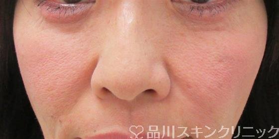 症例NO.30984のAFTER写真
