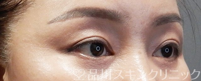 症例NO.73276のAFTER写真