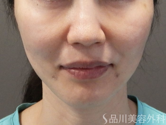 症例NO.69175のAFTER写真