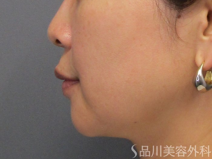 症例NO.74867のBEFORE写真