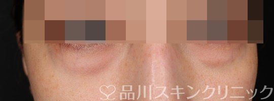 症例NO.74920のBEFORE写真