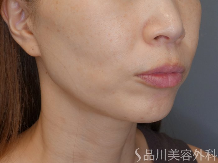 症例NO.71335のBEFORE写真