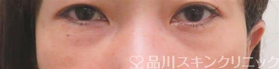 症例NO.56022のAFTER写真
