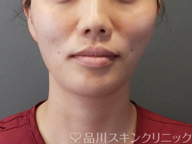 症例NO.65894のAFTER写真