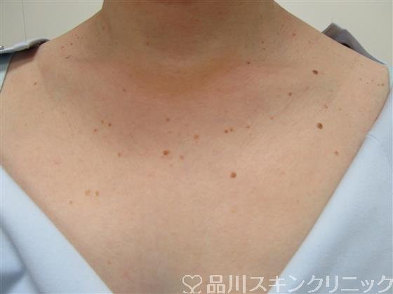 症例NO.36551のBEFORE写真
