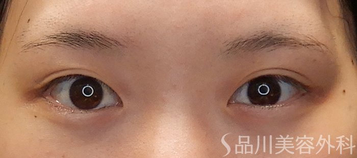 症例NO.71668のBEFORE写真