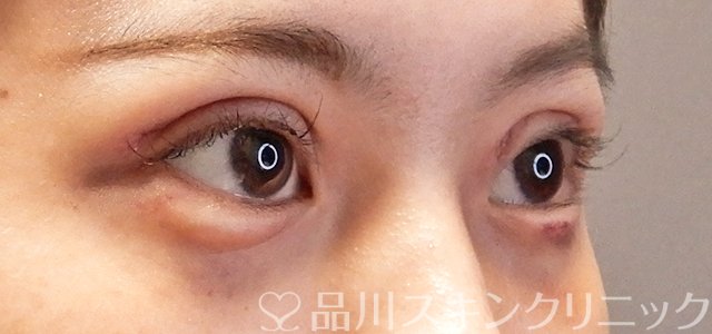 症例NO.67104のAFTER写真