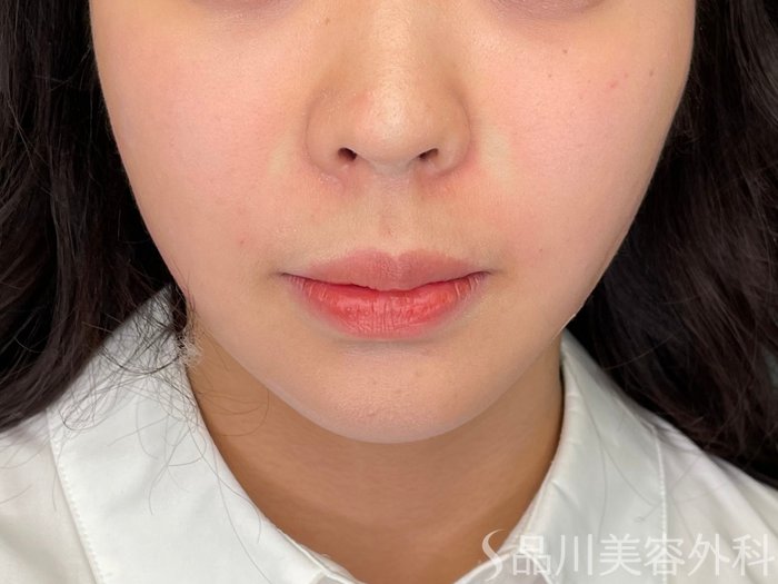 症例NO.73412のAFTER写真