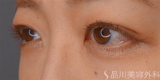症例NO.59012のAFTER写真
