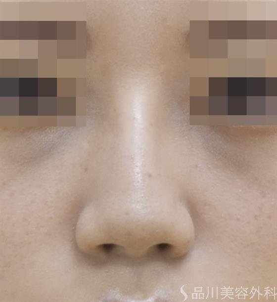症例NO.45651のAFTER写真