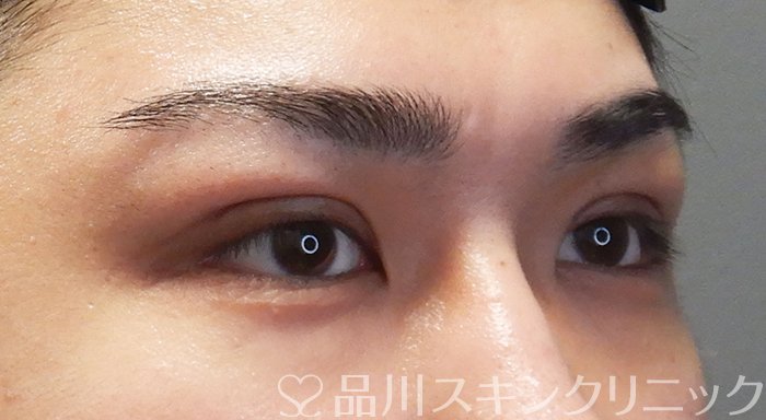 症例NO.69613のAFTER写真