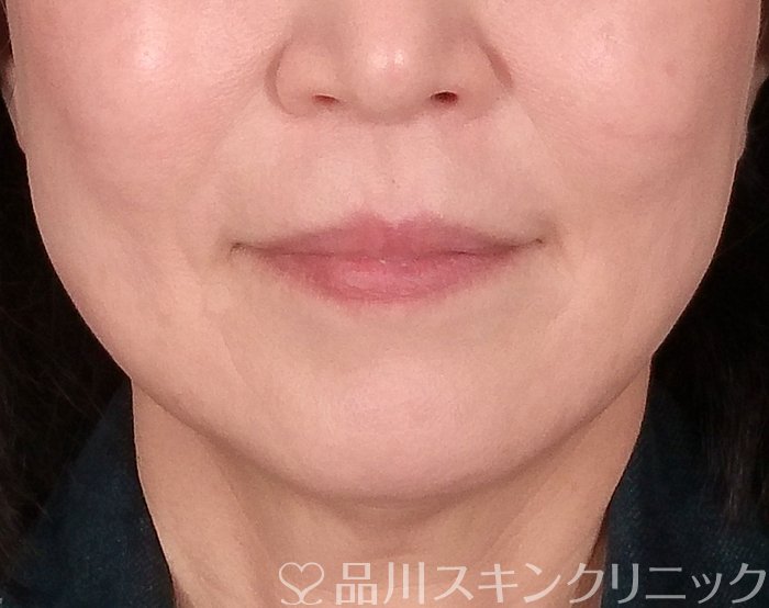 症例NO.69428のAFTER写真