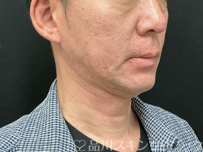 症例NO.73926のBEFORE写真