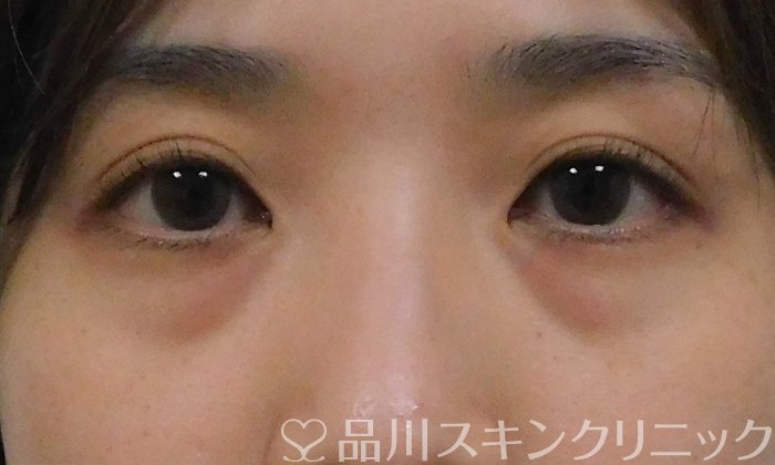症例NO.72069のBEFORE写真