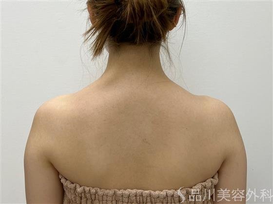 症例NO.55045のAFTER写真