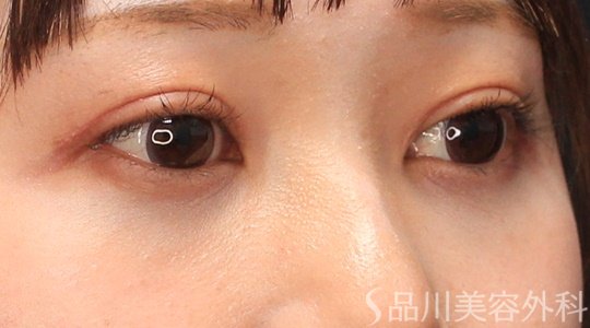 症例NO.70291のAFTER写真