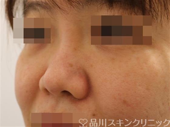 症例NO.39646のBEFORE写真