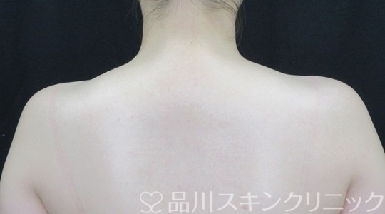 症例NO.70123のAFTER写真