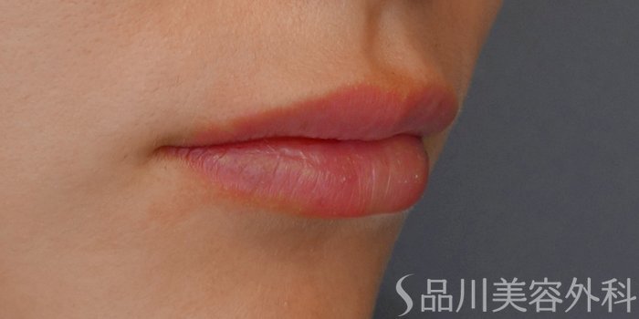 症例NO.71620のAFTER写真