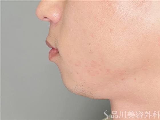 症例NO.54916のBEFORE写真