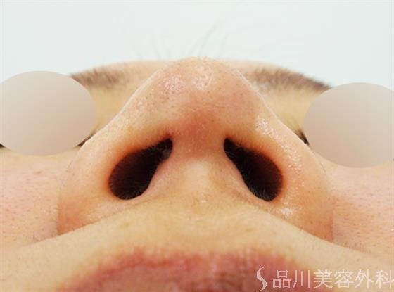 症例NO.46732のAFTER写真