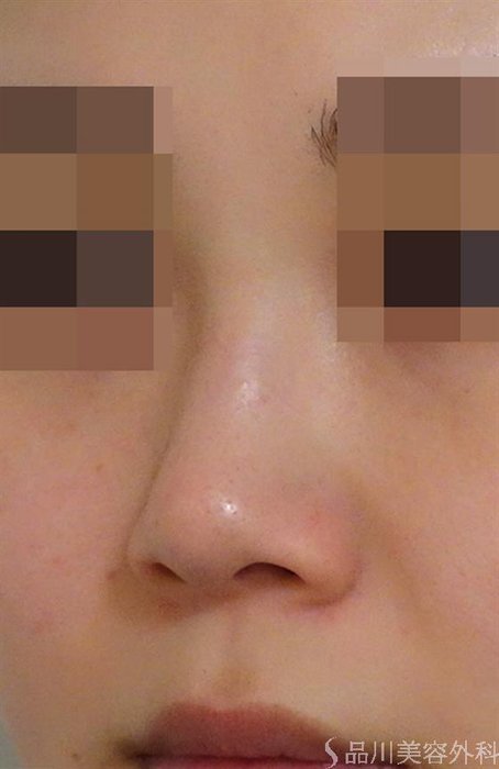 症例NO.44042のBEFORE写真