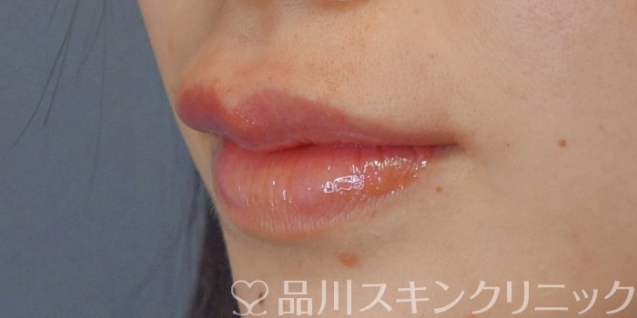 症例NO.72207のAFTER写真