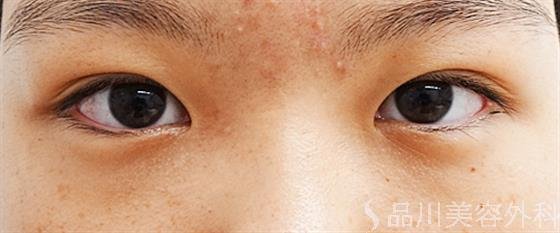 症例NO.48848のBEFORE写真