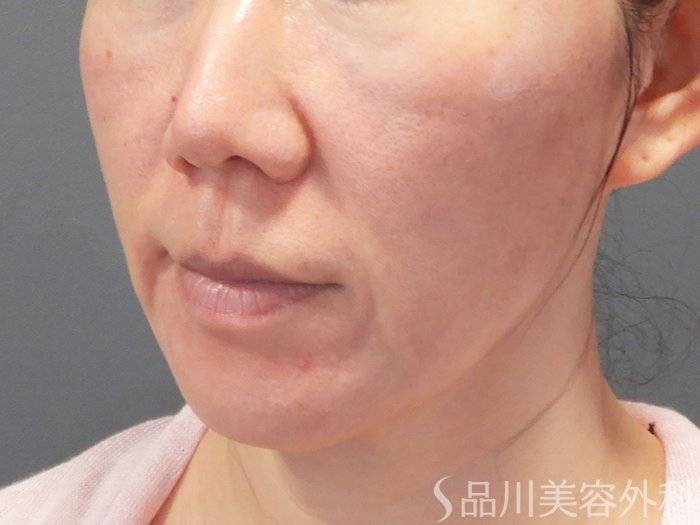 症例NO.71691のBEFORE写真