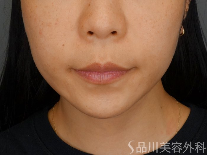 症例NO.72758のBEFORE写真