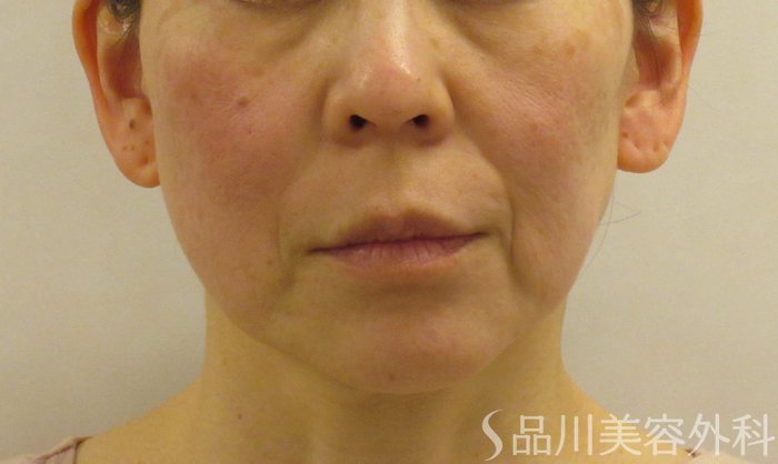症例NO.73221のBEFORE写真