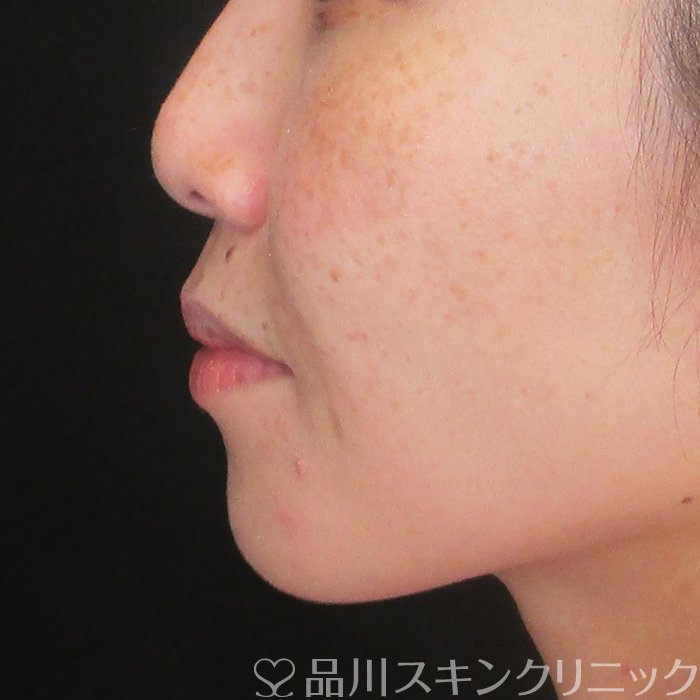 症例NO.72895のAFTER写真