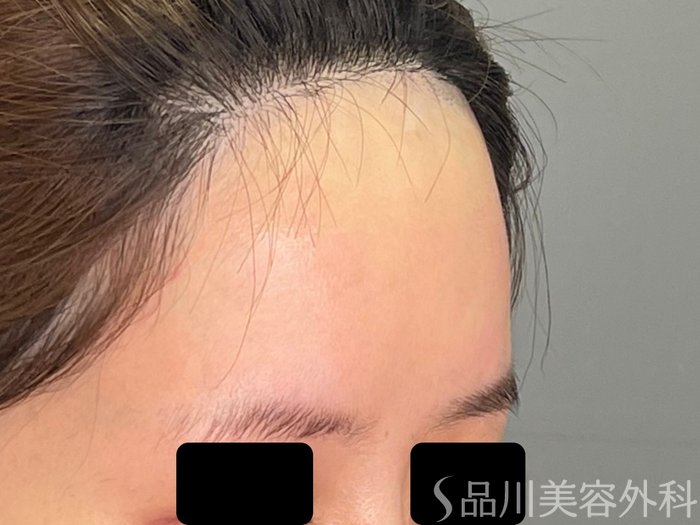 症例NO.71101のAFTER写真