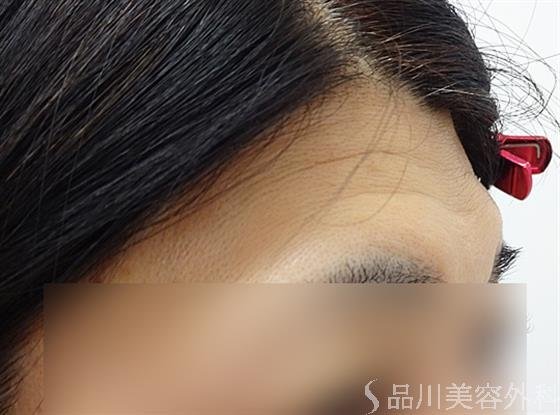 症例NO.36143のBEFORE写真