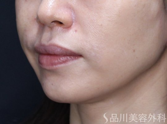 症例NO.73913のAFTER写真
