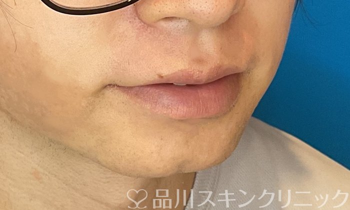 症例NO.74611のBEFORE写真