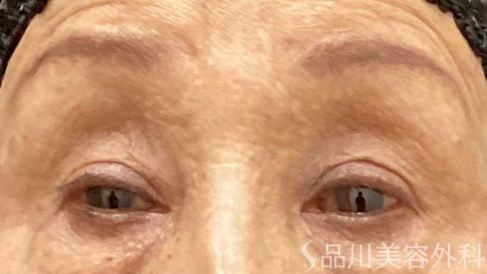症例NO.69511のAFTER写真